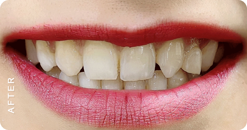 Diastema-closure-with-braces