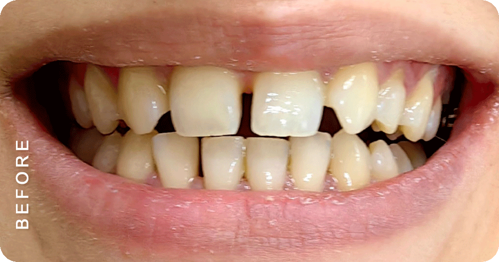 Diastema-closure-with-braces