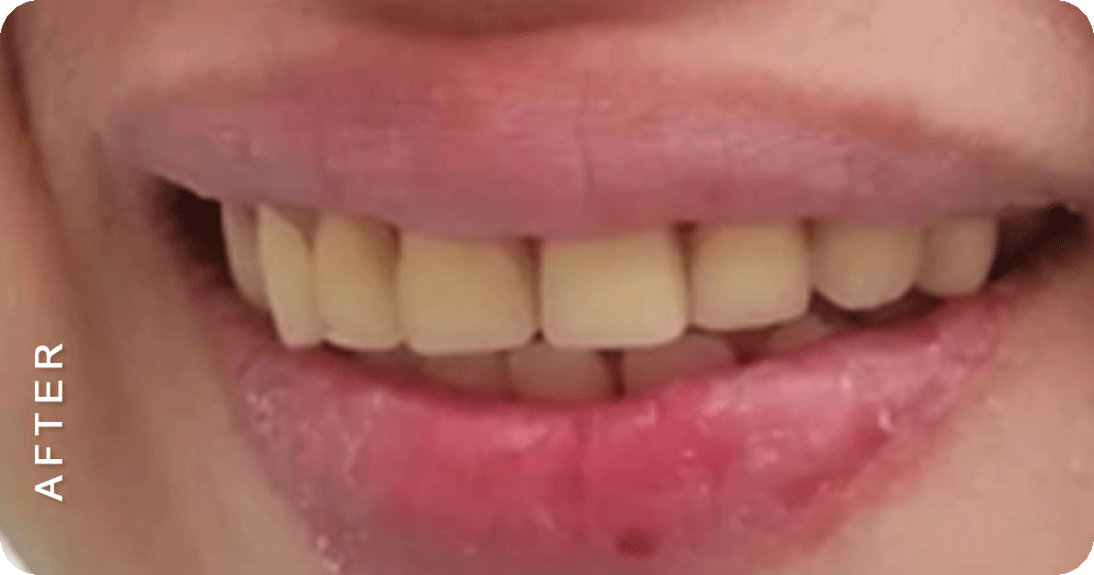 Flexible-Dentures