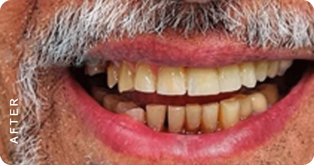 Missing-Tooth