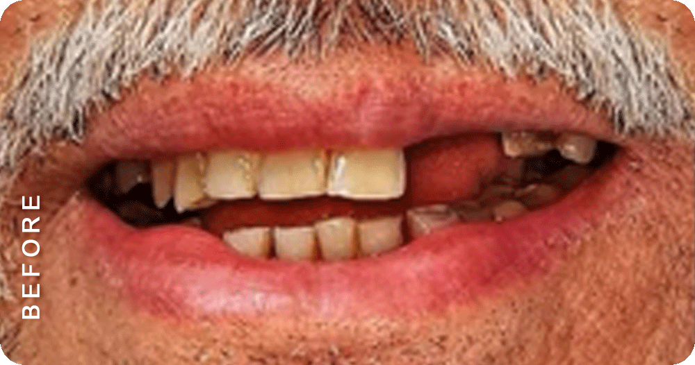 Missing-Tooth