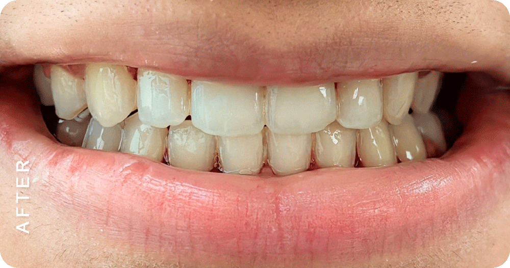 Diastema-closure-with-braces