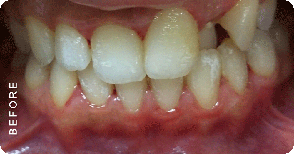 Diastema-closure-with-braces