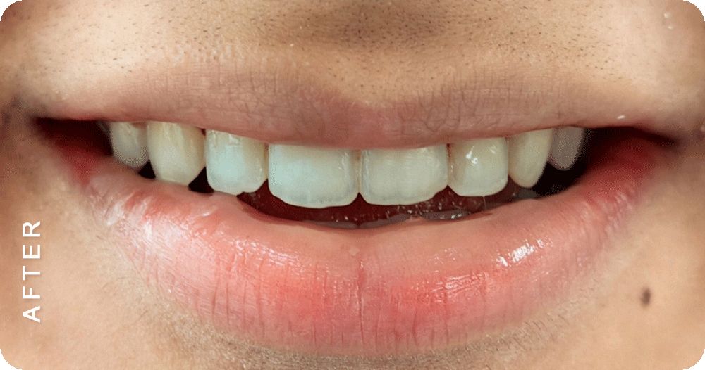 Diastema-closure-with-braces
