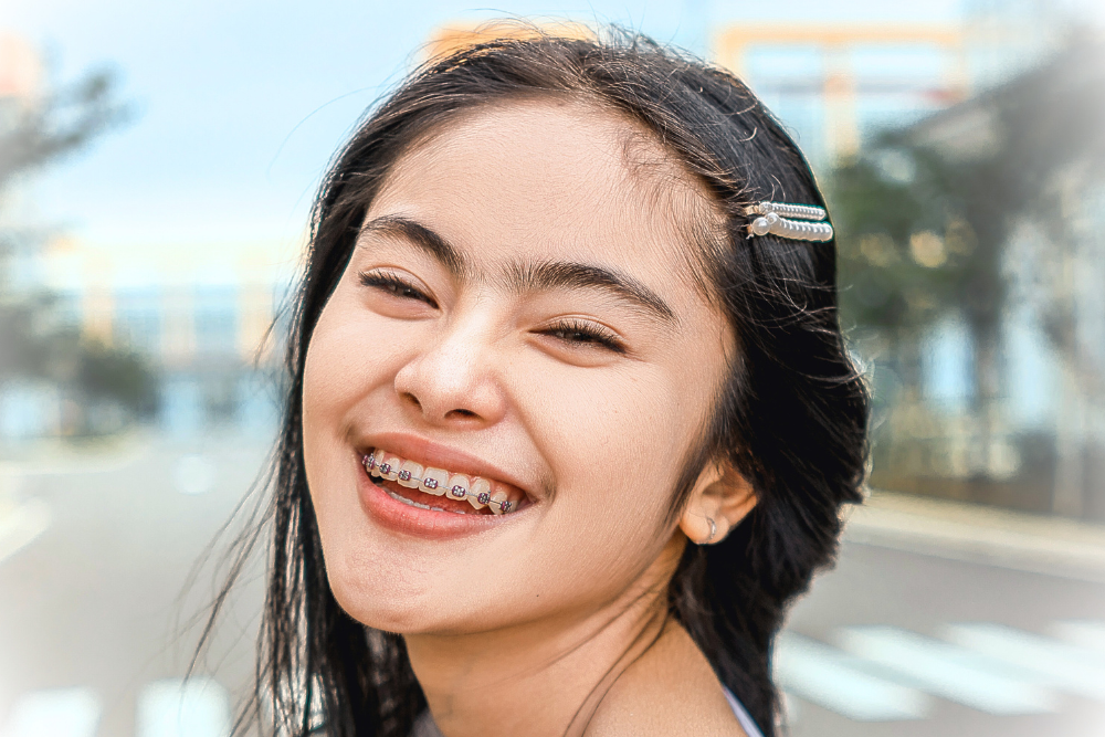 Braces Treatment in Al Nahda