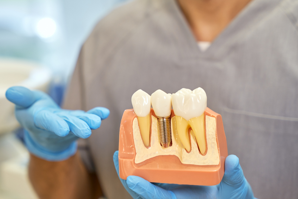 Dental Implant Treatment in Al Nahda