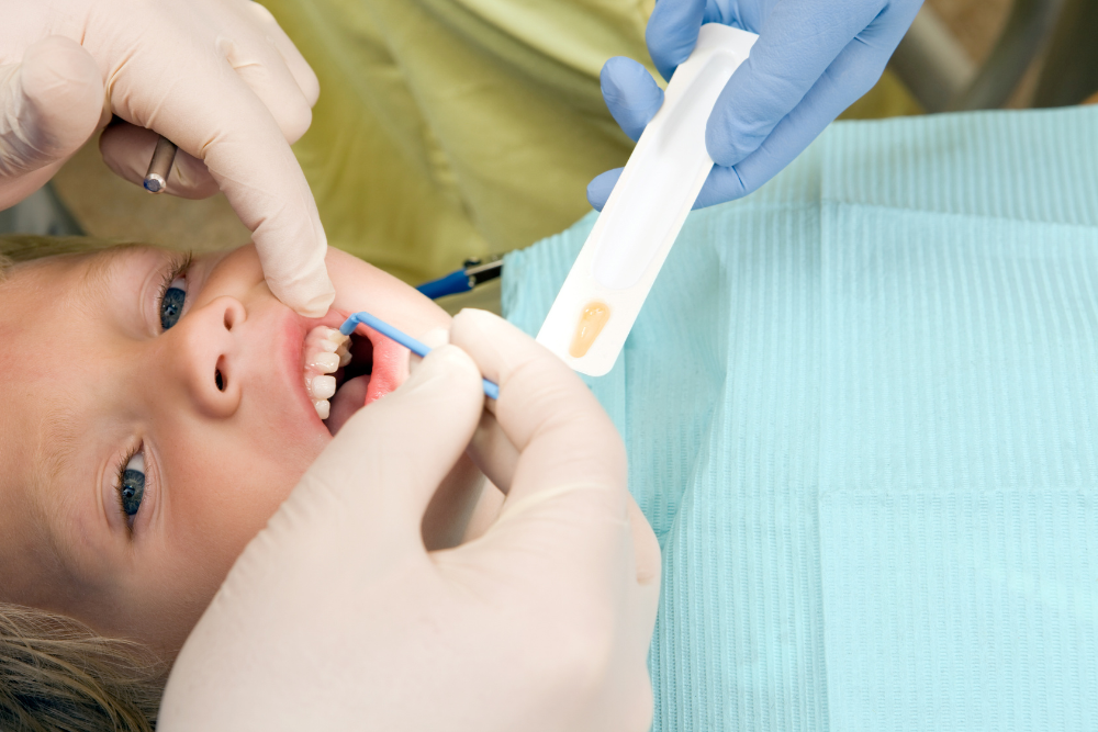 Fluoride & Dental Sealants Treatment in Al Nahda