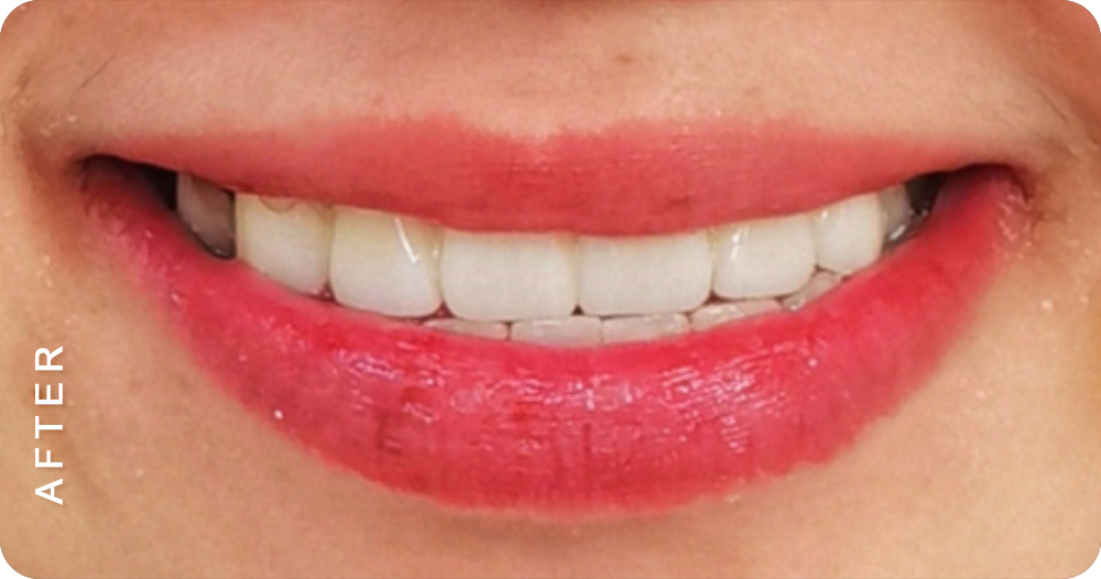 smile makeover