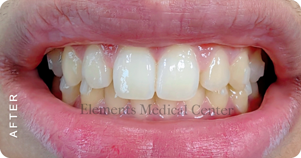 dental crown