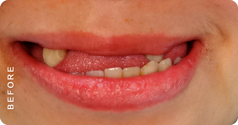 smile makeover