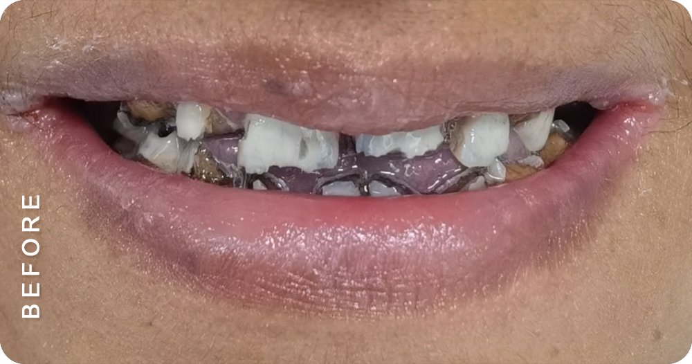 smile makeover