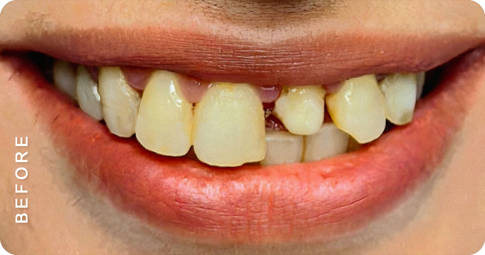 smile makeover