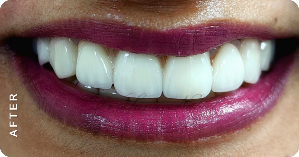 dental crown