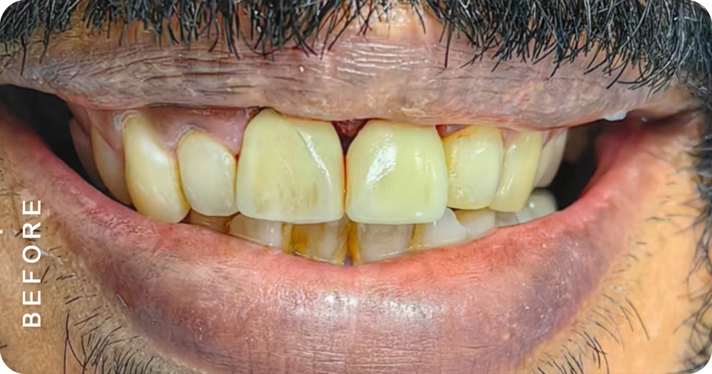 dental crown