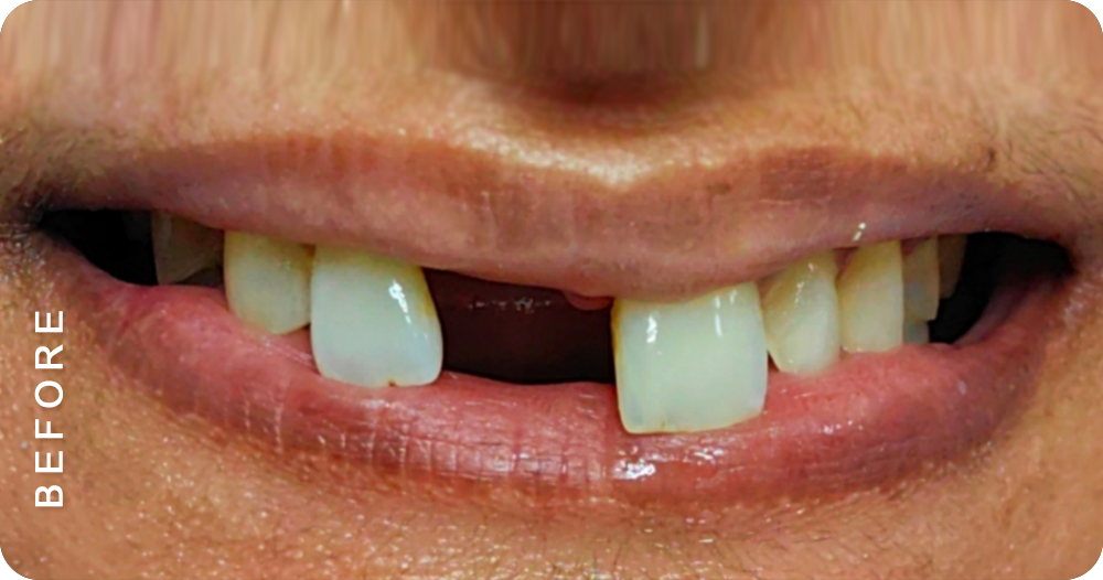 dental crown